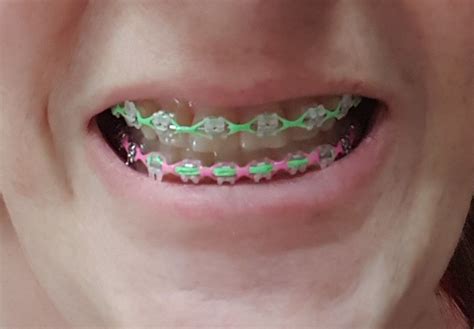 dark green power chain braces